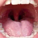 Picture of Tonsil Stones