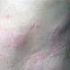 Picture of Urticaria