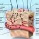 Picture of Varicella (Chickenpox) Virus