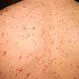 Picture of Varicella Chicken Pox