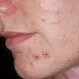 Picture of Varicella-Zoster Virus Infection (Face)