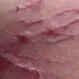 How Do I Get Rid of Spider Veins on My Legs?