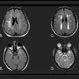 Picture of Vascular (Multi-Infarct) Dementia 2