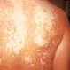 Picture of Vitiligo on Back