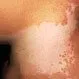 Picture of Vitiligo (Neck)