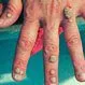 Picture of Warts