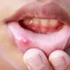 What Causes Blisters on Lips?