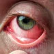 What Are the Best Treatments for Allergic Conjunctivitis?