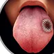 What Does Cancer Look Like on Your Tongue?