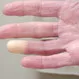 What Is the Difference Between Chilblains and Raynaud's?