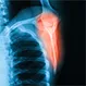 What Causes Scapula Pain?