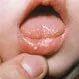 Picture of Yeast Infections (Thrush in Babies)