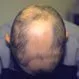 Alopecia Areata