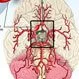 Brain Aneurysm