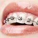 Dental Braces