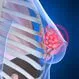 Breast Cancer Clinical Trials