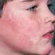 Fifth Disease