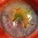 Eye Herpes (Ocular Herpes)