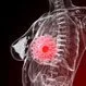 Inflammatory Breast Cancer