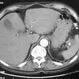 Pancreatic Cysts