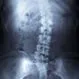 Scoliosis