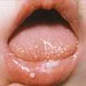 Oral Thrush in Children