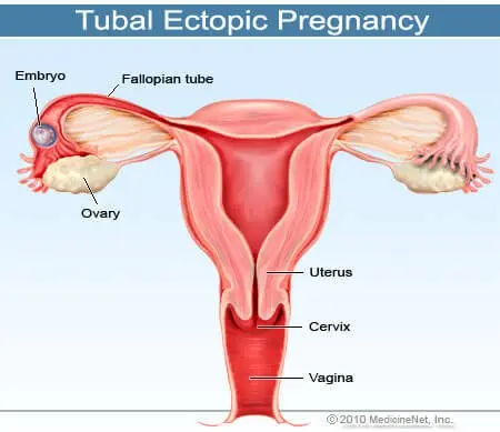 Picture of an ectopic or tubal pregnancy