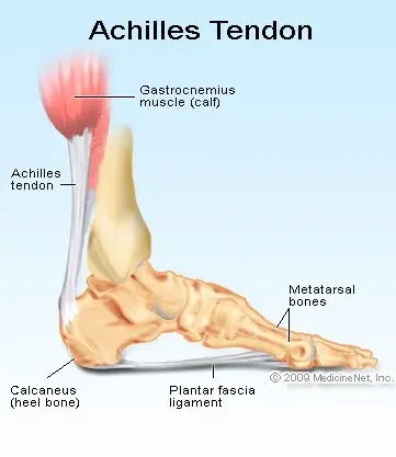 Picture of the metatarsal (foot) and calcaneus (heel) bones, plantar fascia ligament, and Achilles tendon