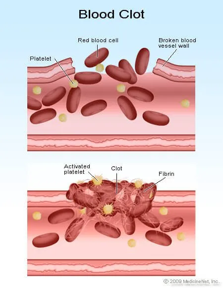 Picture of how red blood cells and platelets form a blood clot