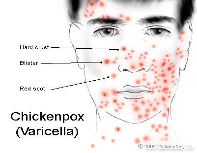 Chickenpox (Varicella)