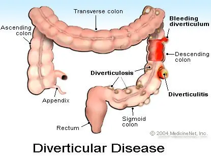 Diverticular disease