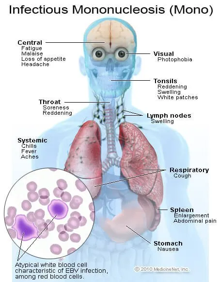 Infectious Mononucleosis Symptoms and Signs