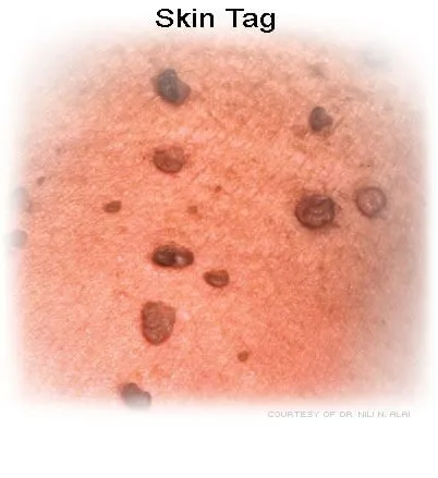 Picture of skin tags