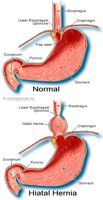 Picture of Hiatal Hernia