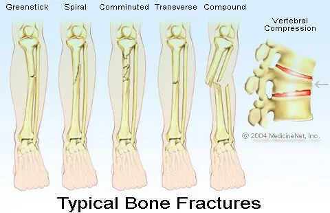 Bone Fractures Illustration - Fracture of Bone