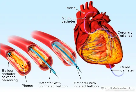 Balloon Angioplasty Illustration