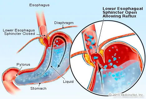 Gastroesophageal Reflux (GERD) Illustration