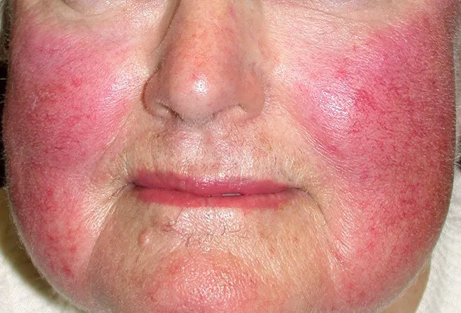 Picture of Rosacea (2 of 2)    