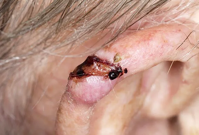 Picture of Basal Cell Carcinoma (Ear)  