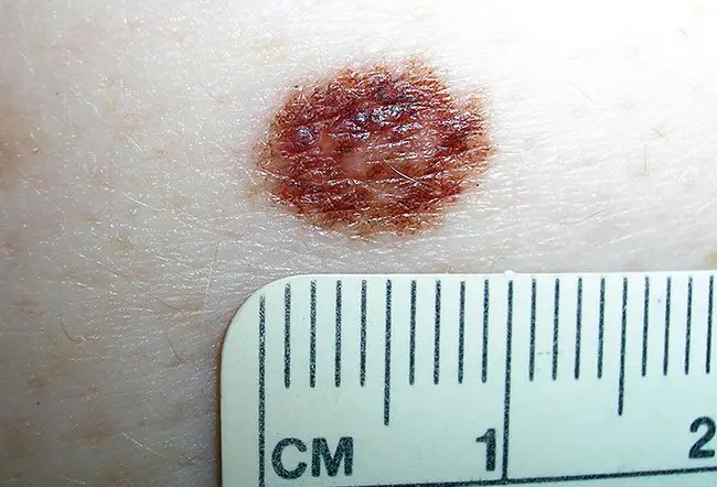 Picture of Dysplastic Nevus