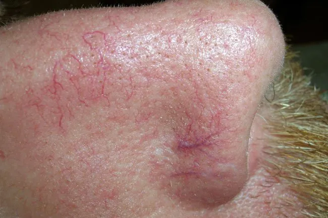 Picture of Facial Telangiectasias.