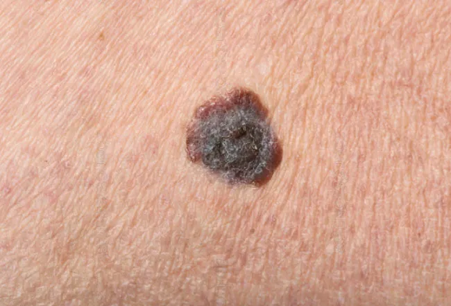 Picture of Malignant Melanoma