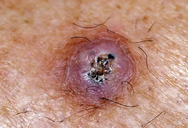 Picture of Squamous Cell Carcinoma with Central Hyperkeratosis