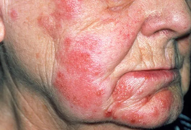 Picture of Varicella-Zoster Virus Infection (Face)