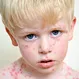 Chickenpox (Varicella) Quiz