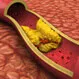 High Cholesterol (Hyperlipidemia) Quiz: Test Your Medical IQ