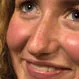 Rosacea Quiz