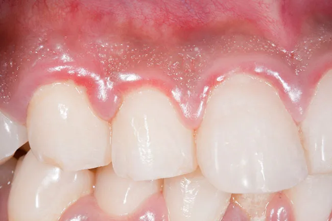 This gum infection may cause serious glucose changes in your blood, too.