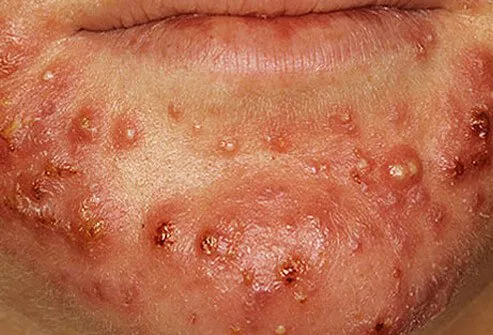 This type of acne is more common in men than women.