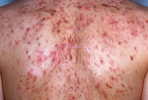 If systemic symptoms like fever or arthritic symptoms develop in patients with acne conglobata, the disease is termed acne fulminans.